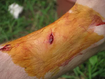 Раны на руке человека стоковое изображение. изображение насчитывающей кровь  - 65162525