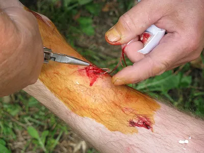 Падения с велосипеда: как лечить раны - Велосайт.ру