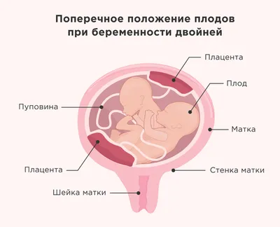 Генетические тесты, тест Panorama, Тест Horizon, Тест Anora, Тест Вистарa,  Неинвазивные пренатальные тесты