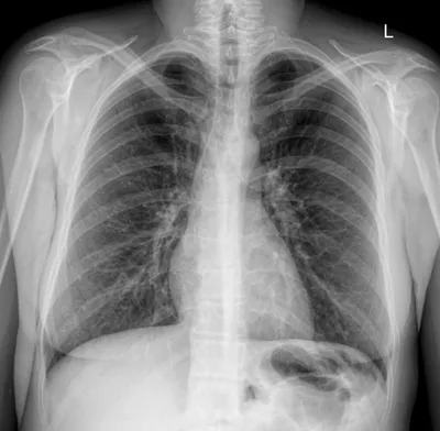Рентген легких или флюорограмма. В чем разница? - блог клиники Доступная  медицина