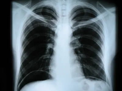 Как выглядят легкие здорового человека на рентгене