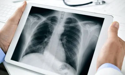 Рентген лёгких