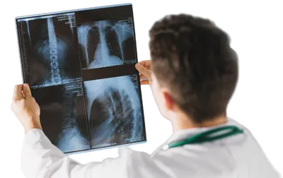 Рентген Легких Больного Человека — стоковые фотографии и другие картинки  Рак лёгких - Рак лёгких, Лёгкое, Опухоль - iStock