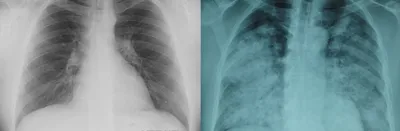 Изображение рентгена легких здоровой женщины Стоковое Изображение -  изображение насчитывающей клетка, рентгенографирование: 30188669