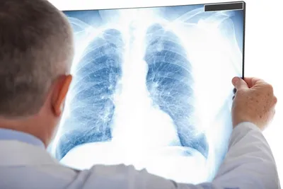 Флюорография и рентген легких: в чем разница