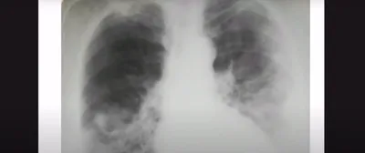 Рентген грудной клетки у детей. Очаговая пневмония. - YouTube
