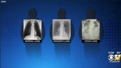 Донские власти показали рентген легких людей, которые заражены  коронавирусом | ROSTOF.RU