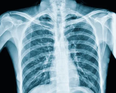 Рентген или КТ при коронавирусе - можно ли делать рентген после КТ легких
