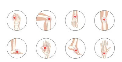 Ревматоидный артрит: симптомы, диагностика, лечение