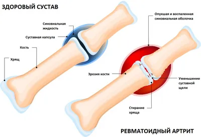 Ревматоидный артрит рук: лечение и симптомы - статьи от компании Еламед