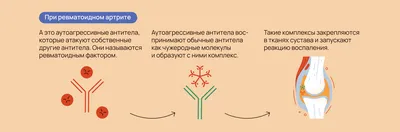 Ювенильный ревматоидный артрит: причины, симптомы, лечение