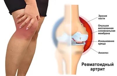 РЕВМАТОИДНЫЙ АРТРИТ — Профилактика — ГБУЗ Городская больница Анапы