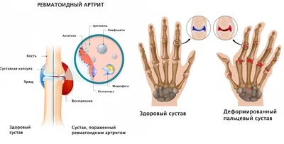 Как вылечить ревматоидный артрит - статьи от компании Еламед