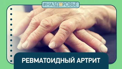 Артрит пальцев рук ревматоидного артрита: причины, симптомы и лечение -  YouTube