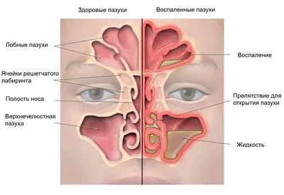 Ринит - симптомы и лечение у взрослых, детей | Солнышко