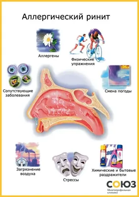 Лечение вазамоторного, аллергического, атрофического ринита - цена на  лечение в клинике СОЮЗ