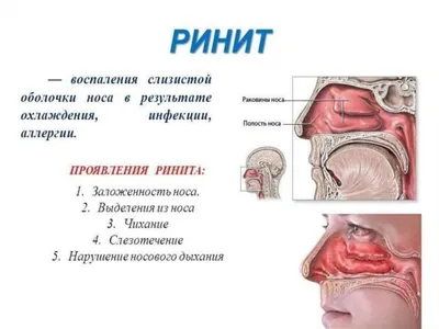 Ринит (насморк):Симптомы ринита,Причины ринита у взрослых и  детей,Диагностика ринита | doc.ua