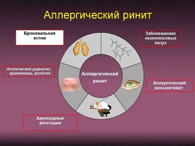 Сезонный аллергический ринит: основные симптомы и методы лечения ᐉ Сеть  аптек «Бажаємо здоров'я»