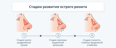 Ринит у взрослых: признаки и лечение, методы и средства