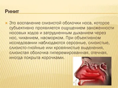 Ринит: острый и хронический – диагностика и лечение в МДЦ «ОЛИМП» Москве
