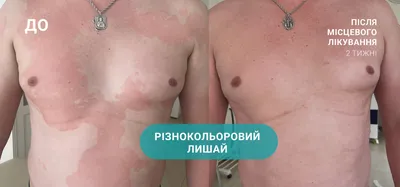 Розовый лишай. | татьяна кузьмина | Дзен