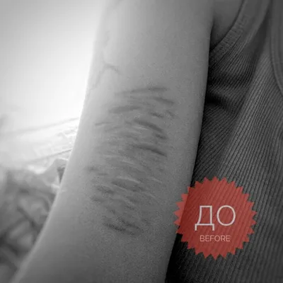 Перекрытие шрамов в Пензе - Татуировки - Красота: 14 тату-мастеров со  средним рейтингом 4.9 с отзывами и ценами на Яндекс Услугах