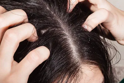 Себорея волосистой части головы: причины, диагностика, лечение. - Мир  здоровья - сеть клиник в Санкт-Петербурге