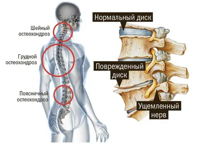 ВСД и остеохондроз. Симптомы вегетососудистой дистонии с шейным  остеохондрозом.