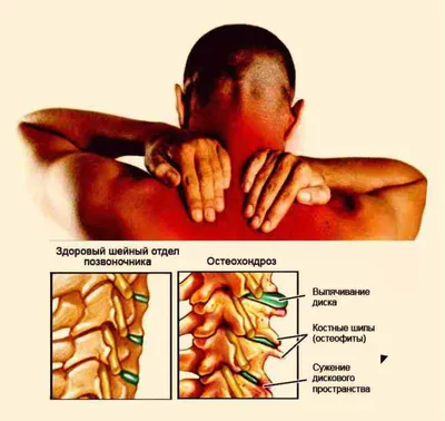 Шейный остеохондроз. Упражнения ЛФК и массаж - YouTube