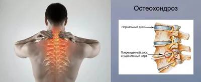 Как лечить давление при шейном остеохондрозе в Ростове