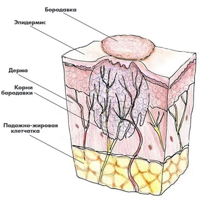 Что такое шипица, и как от нее избавиться?