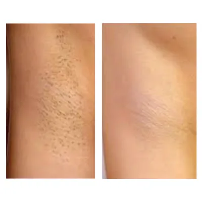 Лазерная эпиляция глубокого бикини: фото до и после, идеальная гладкость  кожи от LaserVille