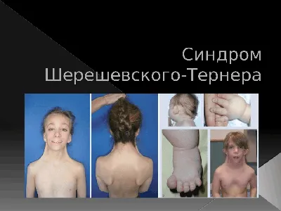 Синдром Шерешевского-Тернера» — создано в Шедевруме