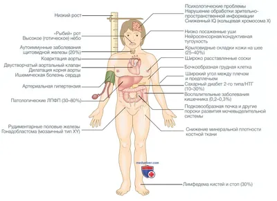 Шерешевського-Тернера | Diapositivas Endocrinología | Docsity