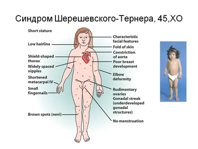 Синдром Шерешевского — Тёрнера: причины, симптомы и лечение в статье  детского эндокринолога Кокорева К. Д.