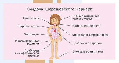 Синдром Шерешевского - Тернера | Справка.Неинвалид.ru