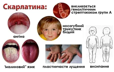 Детская болезнь с осложнениями: после скарлатины можно получить отит и  ревматизм - Новости на KP.UA