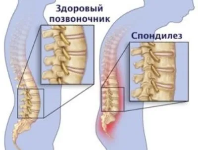 Спондилез