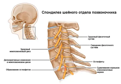 Спондилез позвоночника поясничного, грудного и шейного отдела - лечение и  симптомы