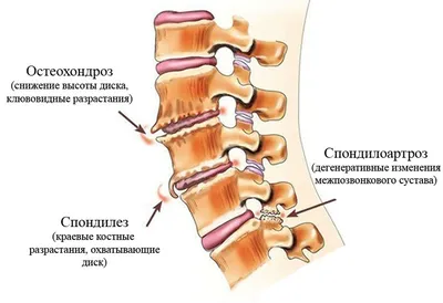 Спондилез грудного отдела позвоночника: особенности и деформирующий  характер заболевания