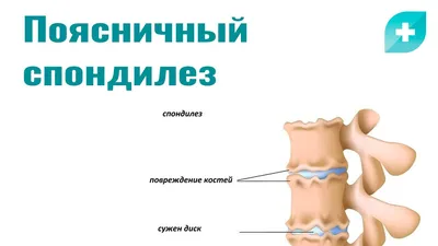 Спондилез стоковое фото. изображение насчитывающей людск - 38473474