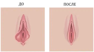 Срамные губы — сладкий ананас