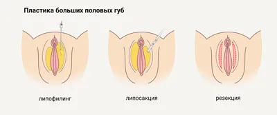 Сращения малых половых губ у девочек периода раннего детства: тактика  детского гинеколога