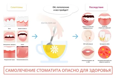 Лечение стоматита Стоматология №2 в Ижевске