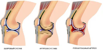 Остеопатия при лечении суставов, работа с коленными суставами