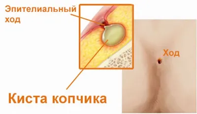 Dr. Artyom Mkrtchyan - ➡️Эпителиальный копчиковый ход (ЭКХ) представляет  собой узкую эпителиальную трубку, расположенную в подкожной клетчатке  межъягодичной складки на уровне копчика и не связанную с крестцом и  копчиком. ▪️С течением времени