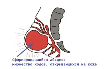 Киста копчика или фурункул: причины, симптомы и лечение