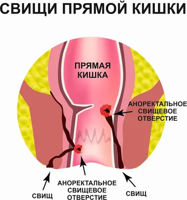 Пилонидальная киста лечение в Екатеринбурге