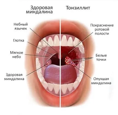 Тонзиллит | Симптомы | Диагностика | Лечение - Lik.ua