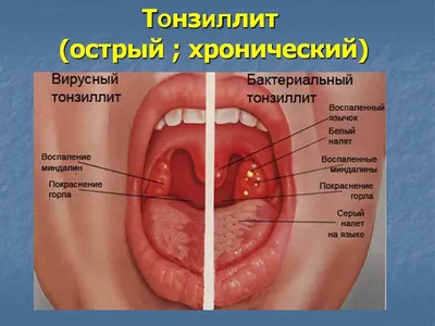 12 842 рез. по запросу «Тонзиллит» — изображения, стоковые фотографии,  трехмерные объекты и векторная графика | Shutterstock